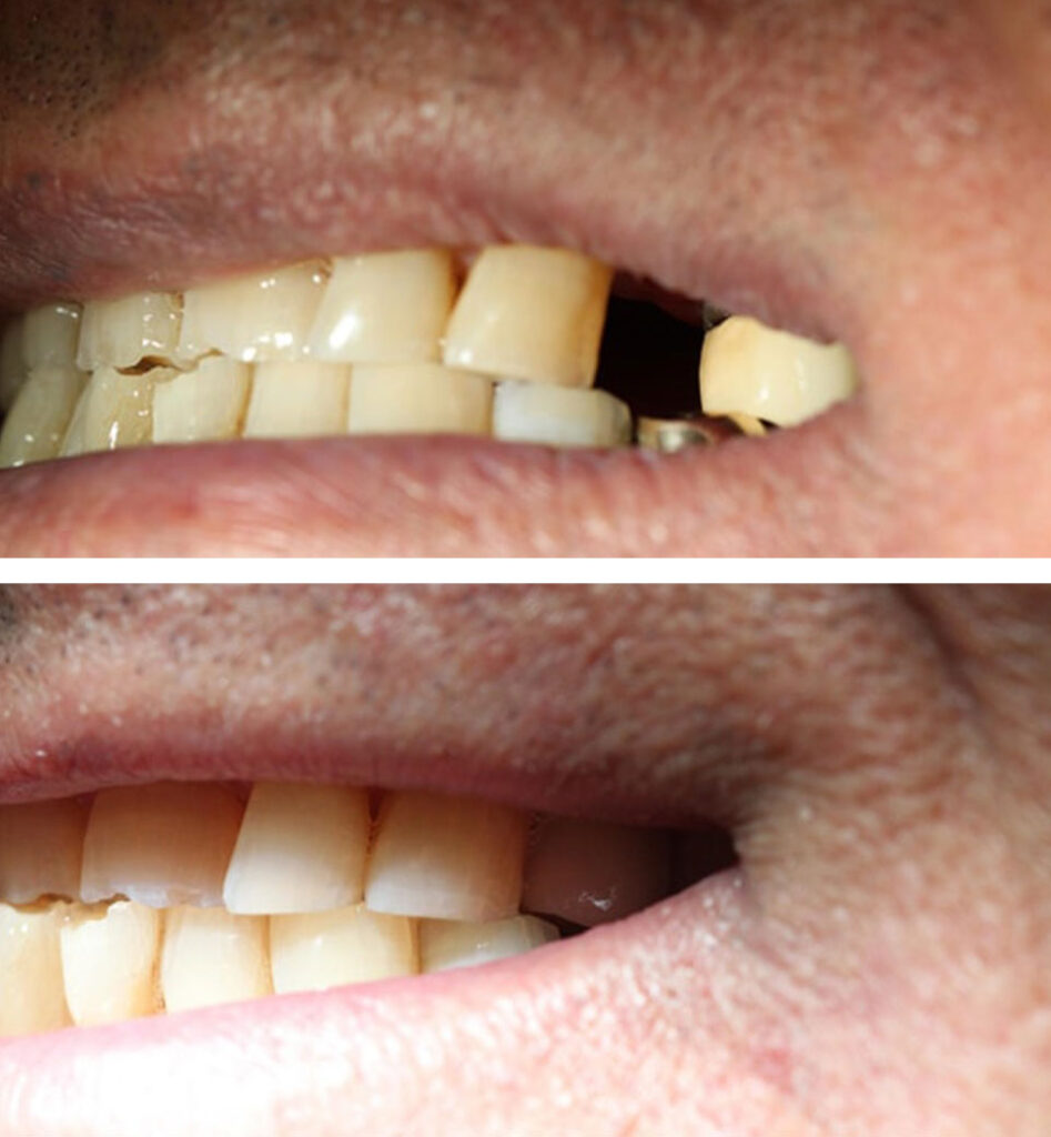 dental implants ba