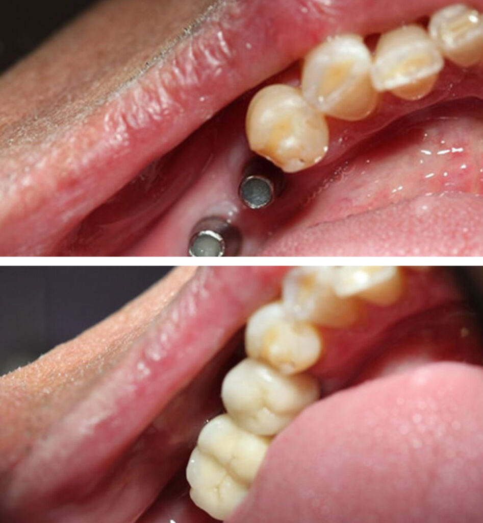 dental implants ba