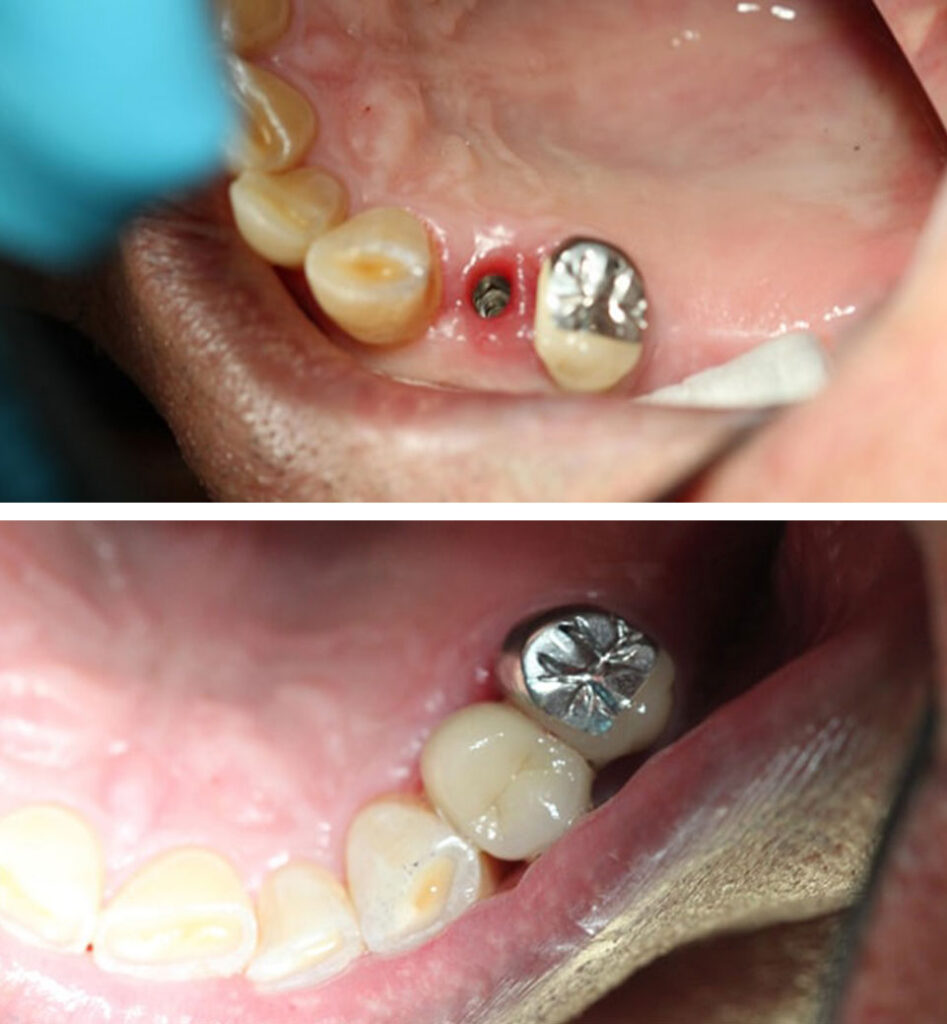 dental implants ba