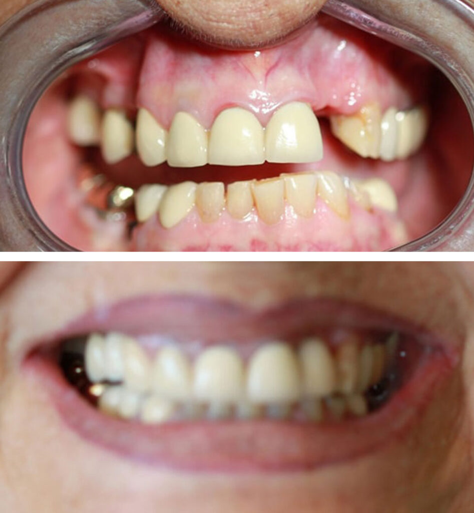 dental implants ba