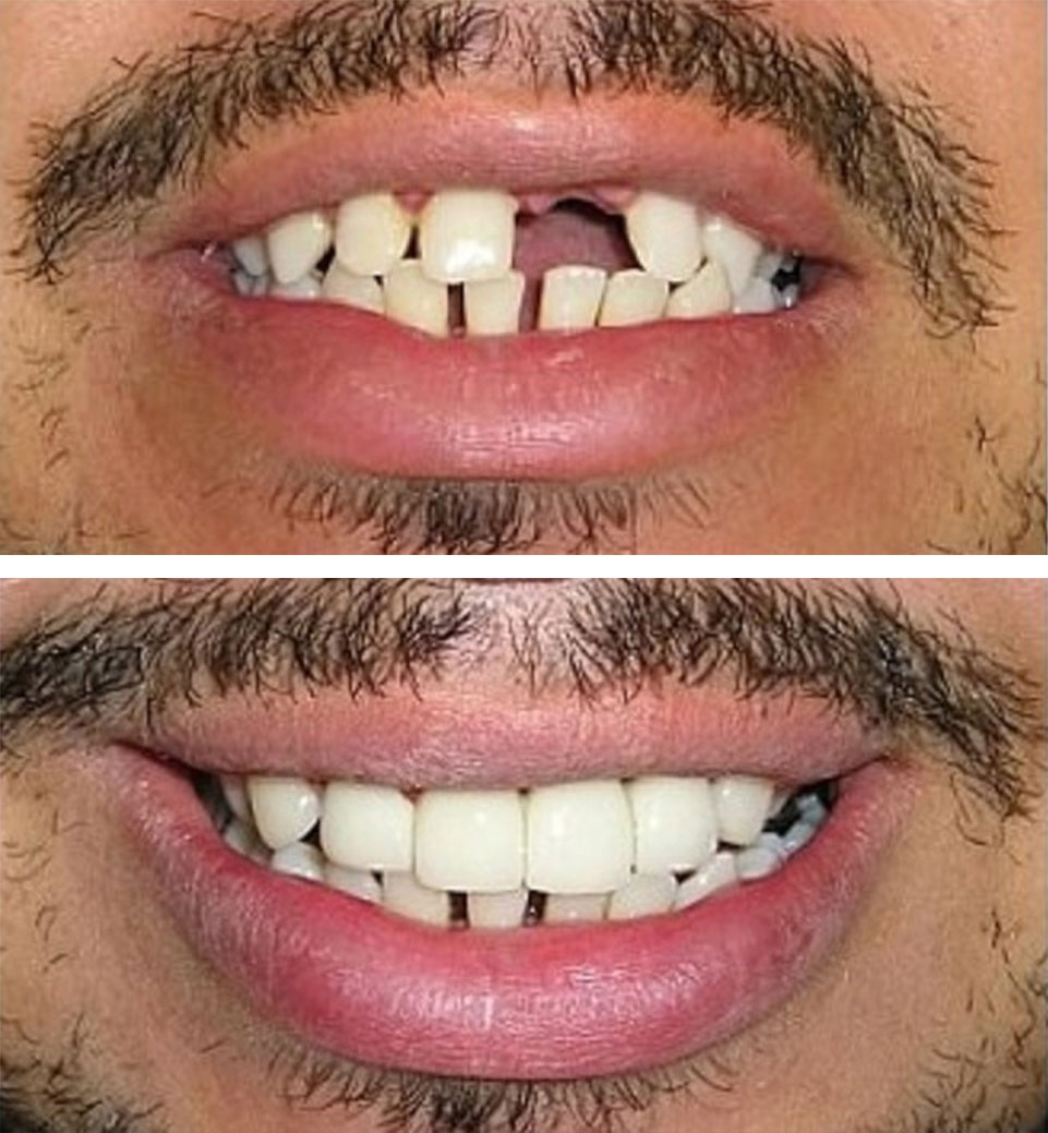dental implants