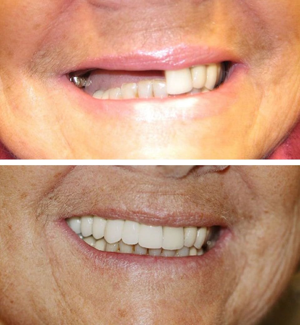 dental implants ba