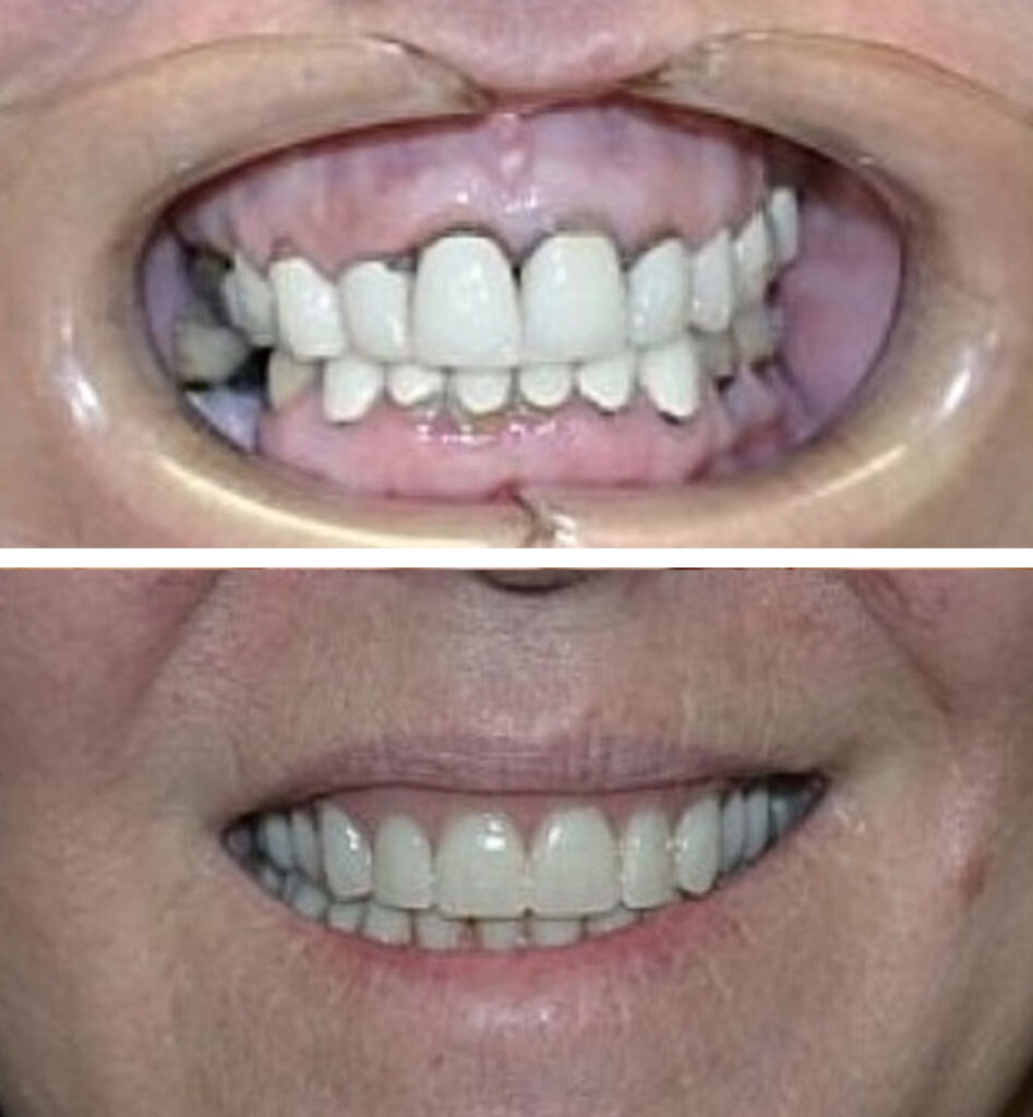 dental implants ba