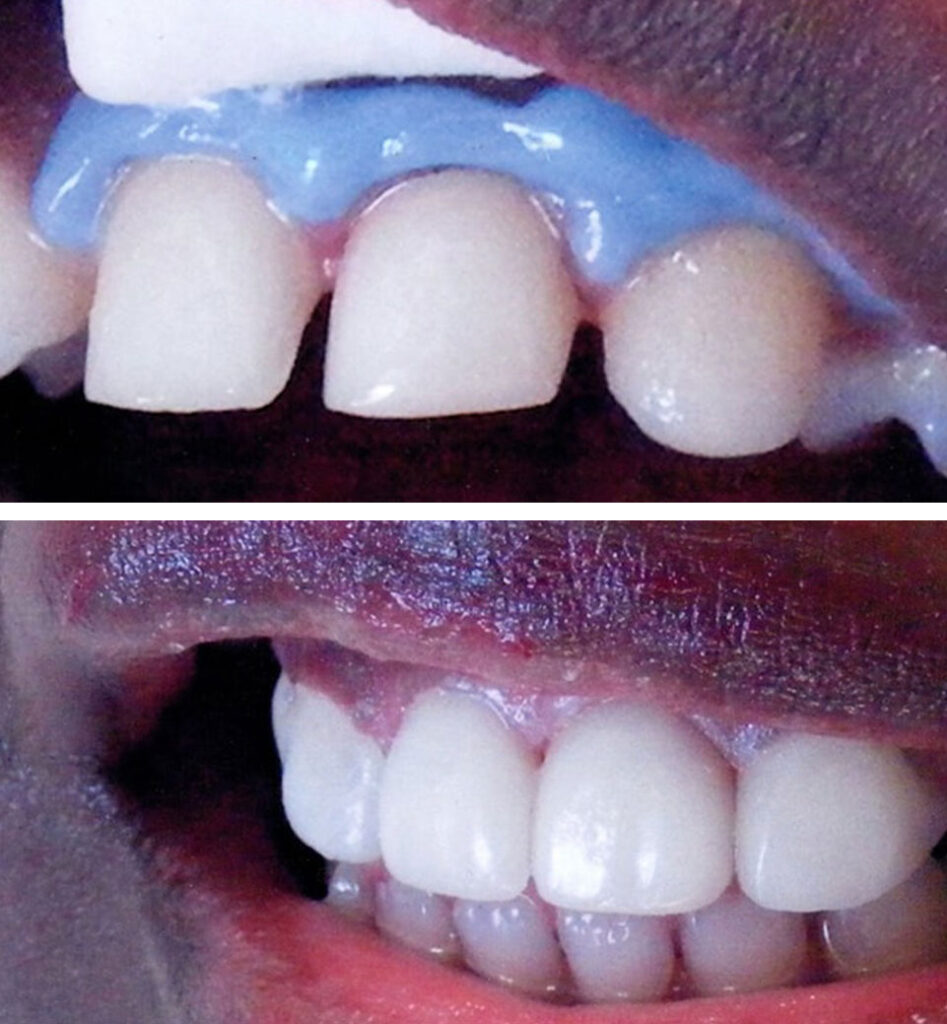 dental implants ba