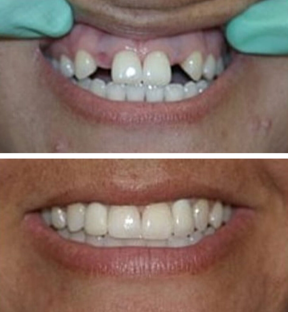 dental implants ba
