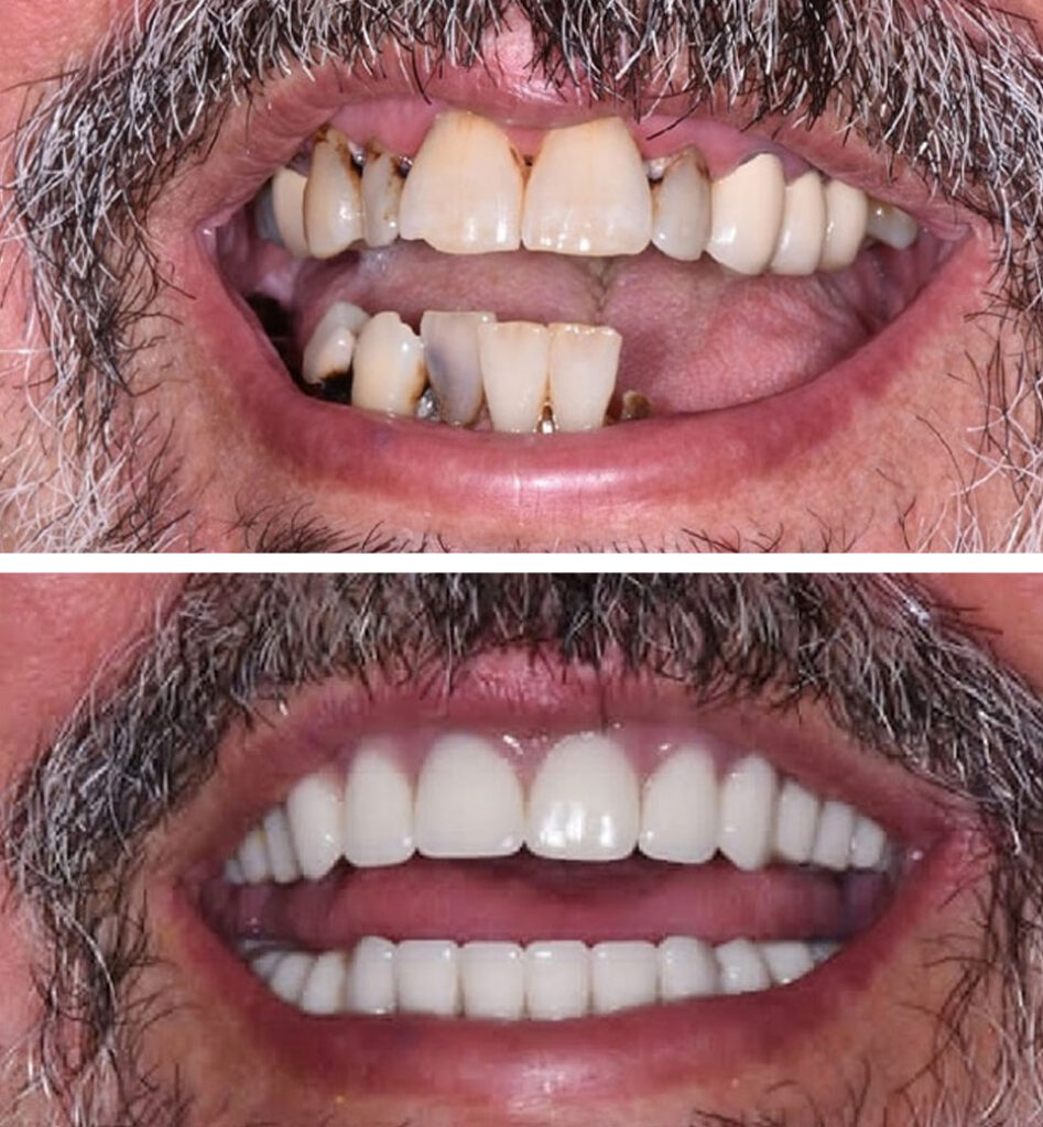dental implants ba