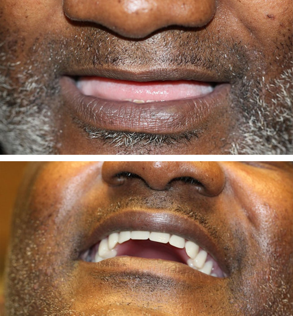 dental implants