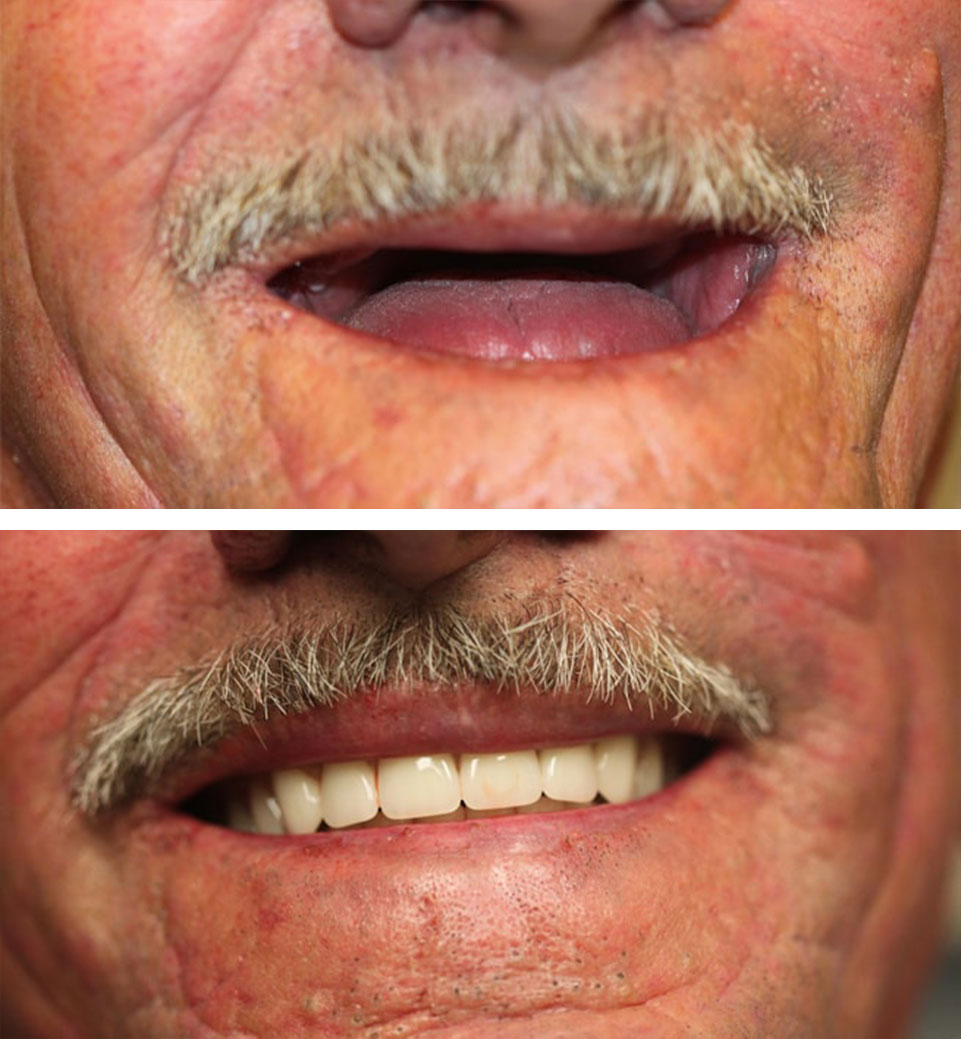 dental implants