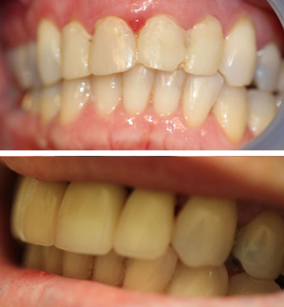 dental implants ba