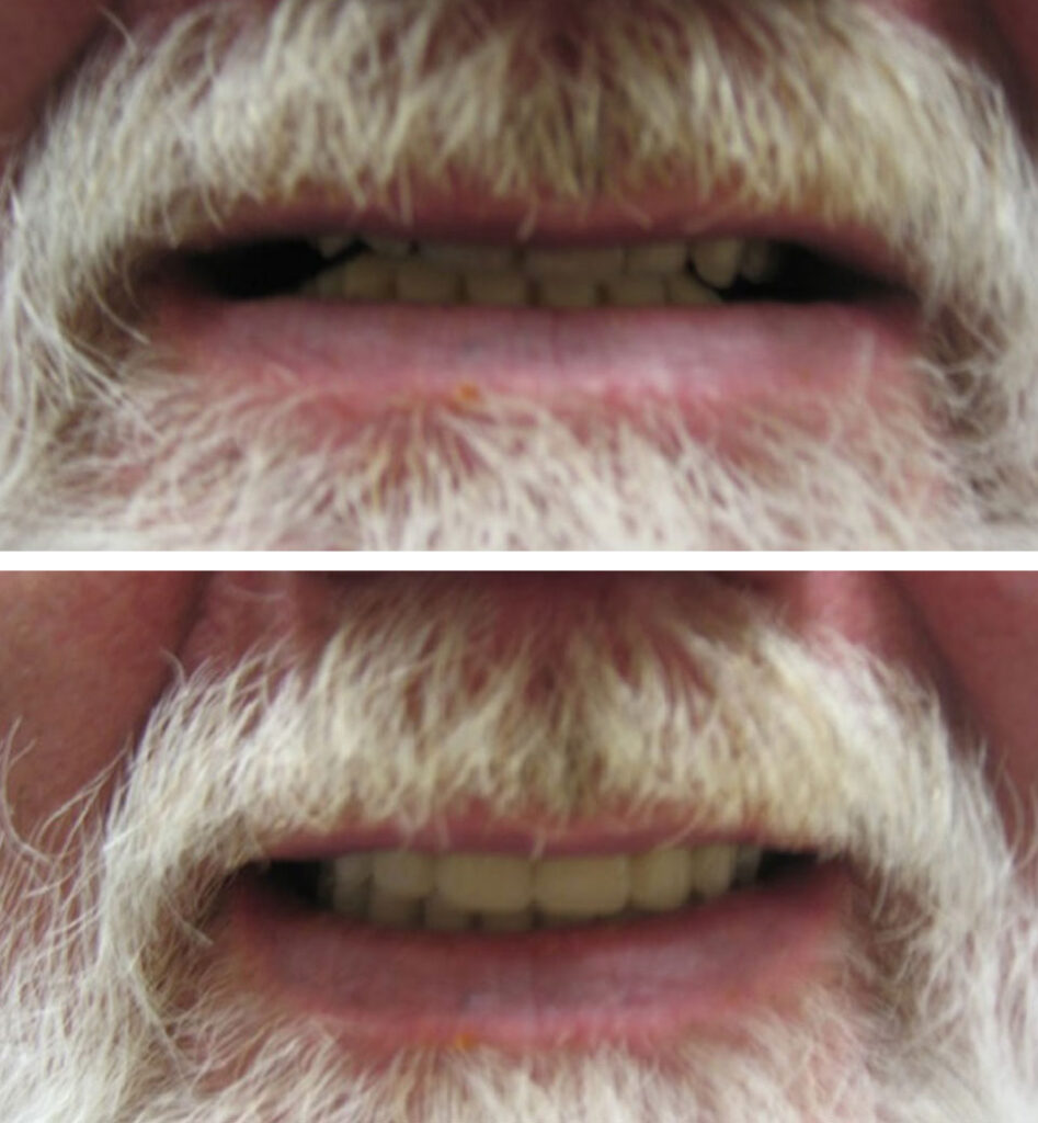 dental implants ba