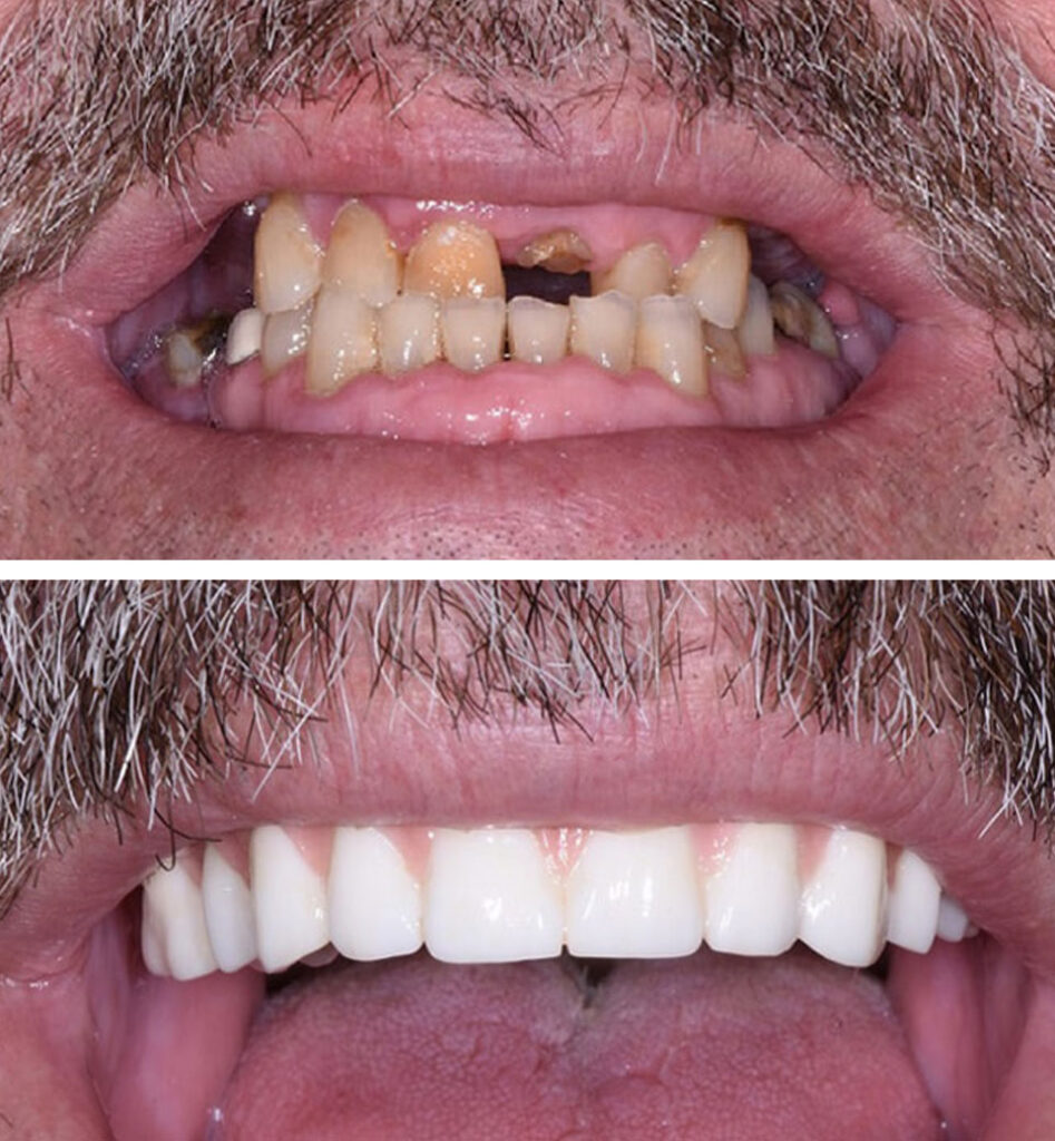 dental implants ba