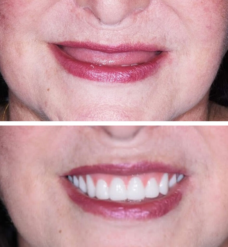 dental implants ba
