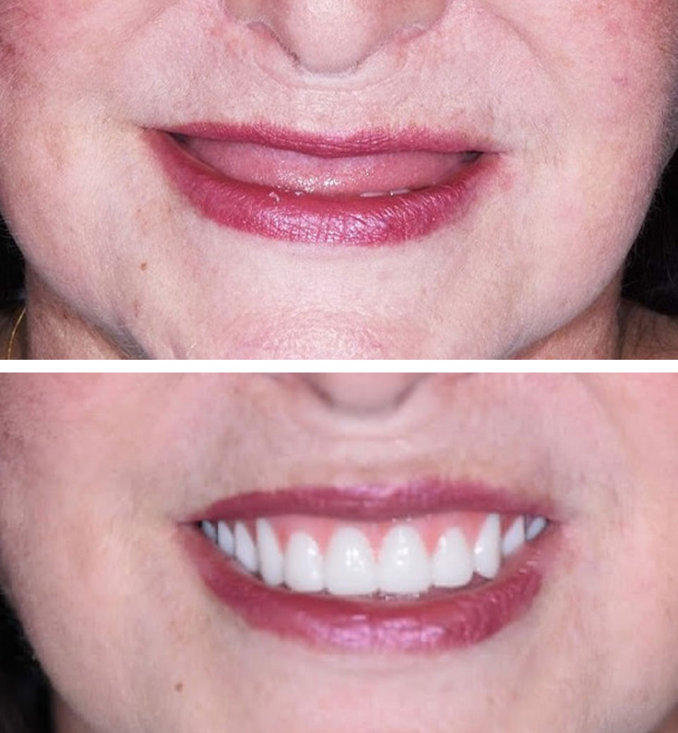 dental implants ba
