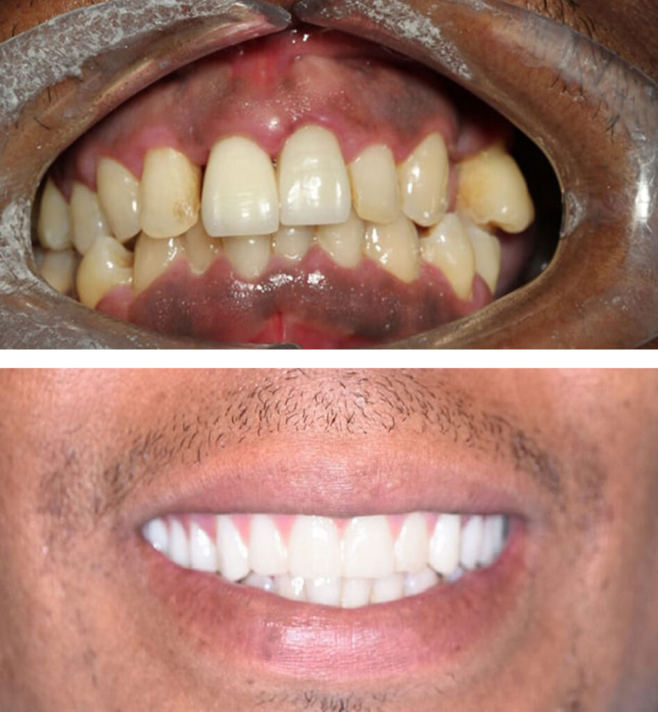 dental implants ba