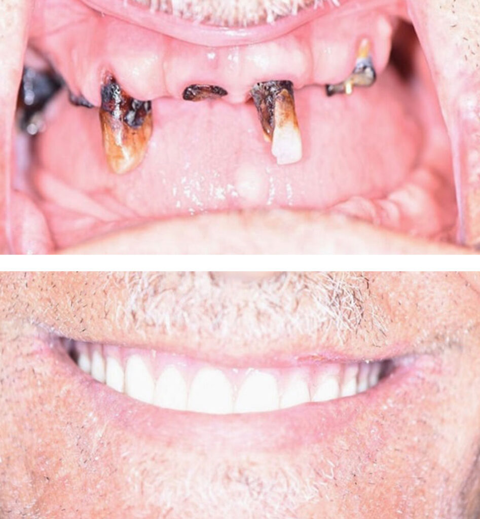 dental implants ba