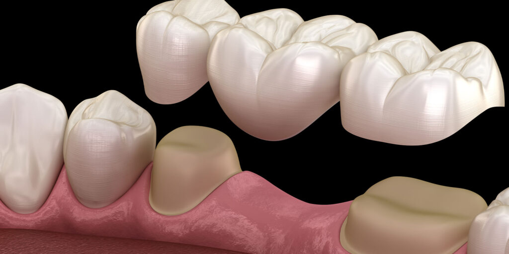 dental crowns