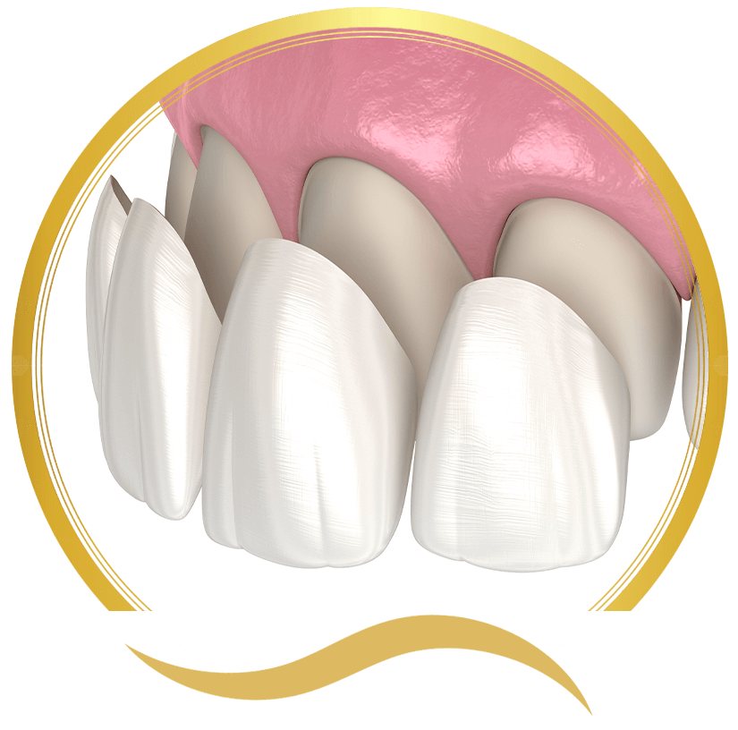 porcelain veneers being placed