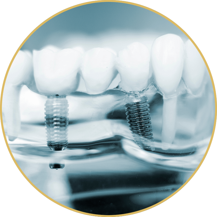 dental bridge