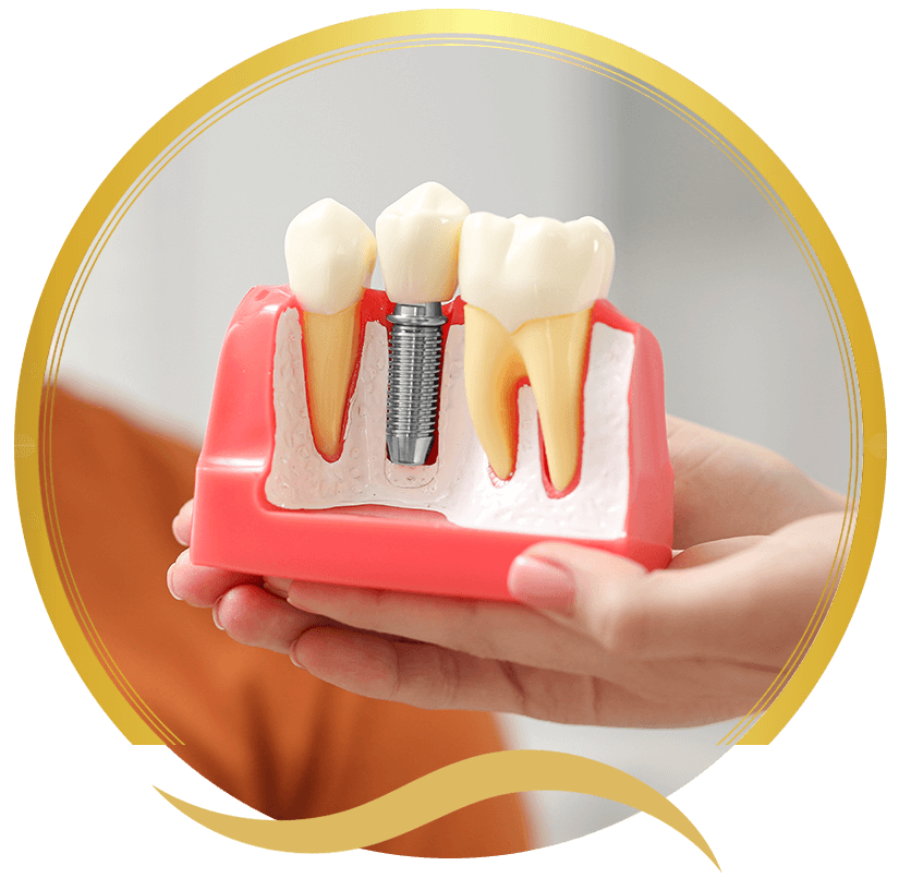 dental implant