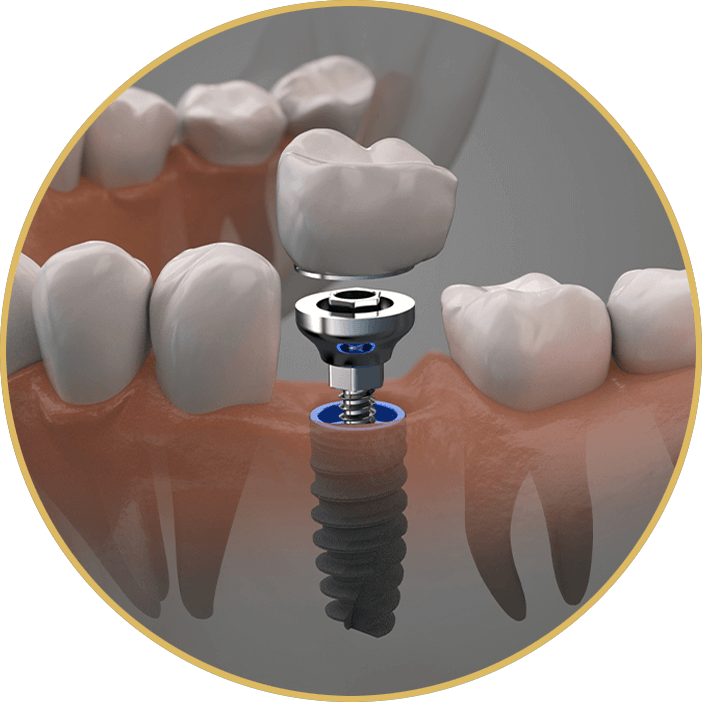 dental implant