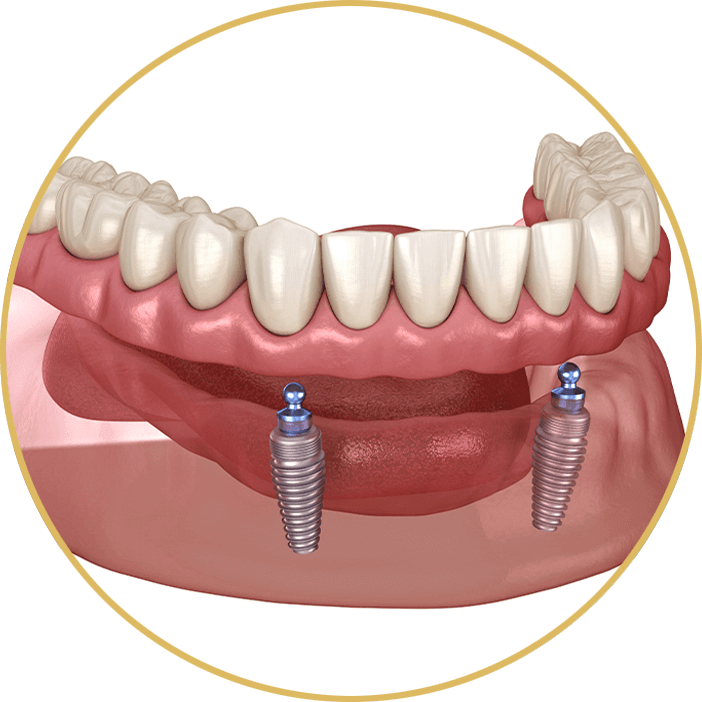 implant supported new gold
