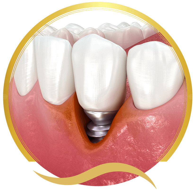 failing dental implant