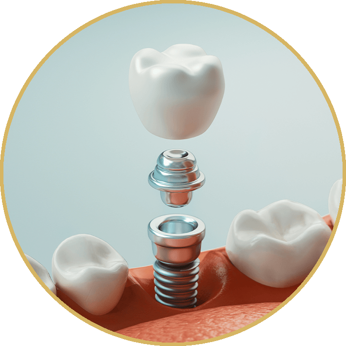 Dental implants