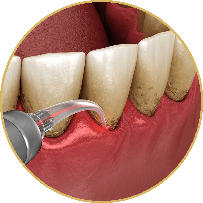 Dental Laser