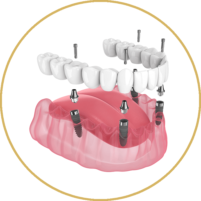 Full arch Implants
